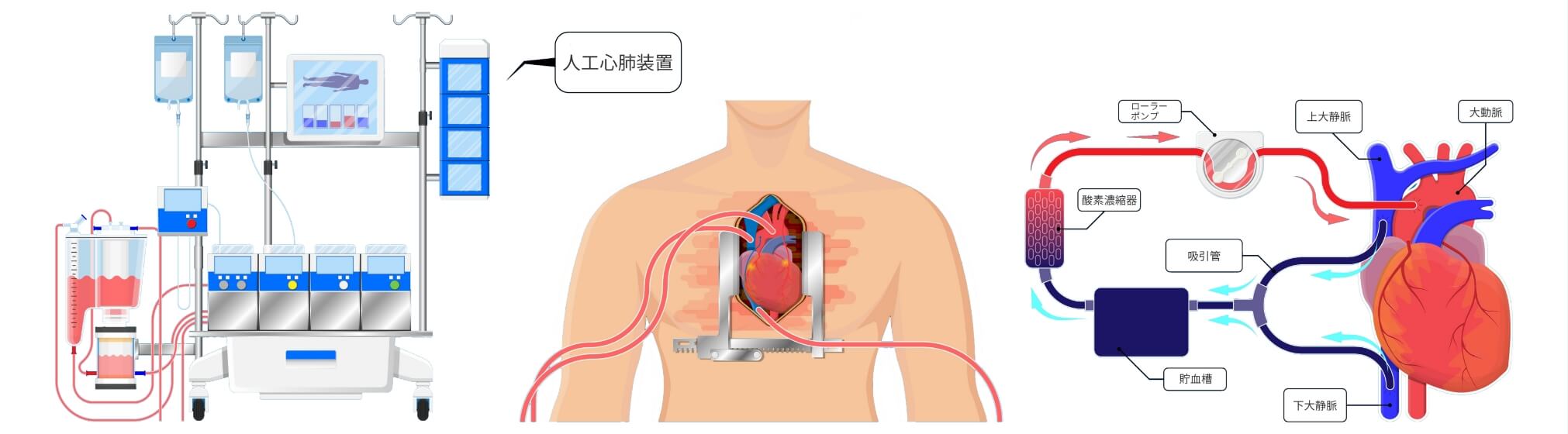 心停止下冠動脈バイパス術（人工心肺下冠動脈バイパス術）の説明図