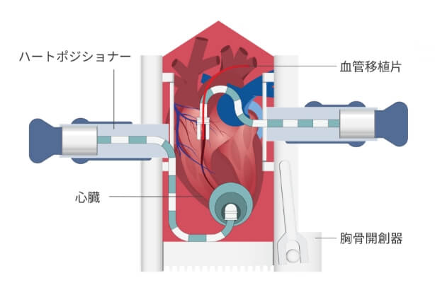 心拍動下冠動脈バイパス術（OPCAB）の説明図