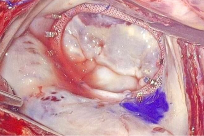 MICSカメラ映像【手術後】