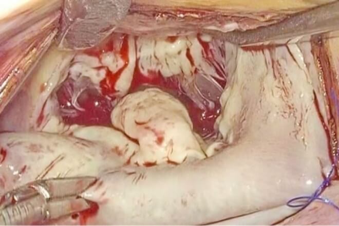 MICSカメラ映像【手術前】