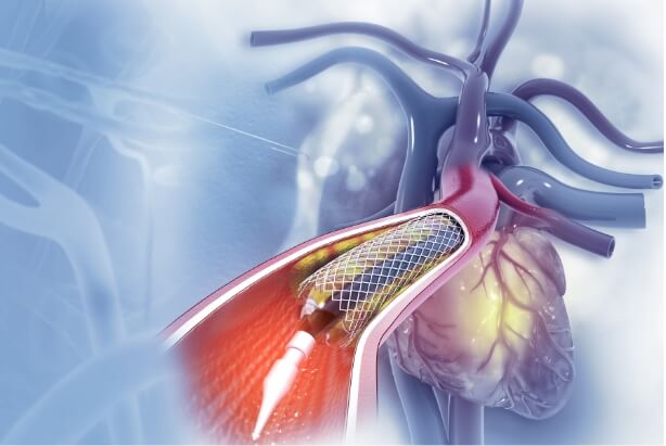 ステントグラフトの説明図