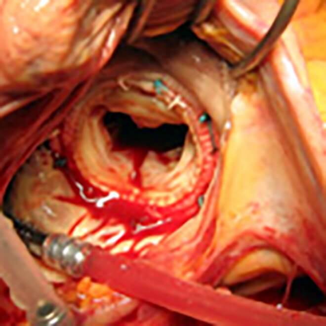 生体弁による僧帽弁置換術の写真