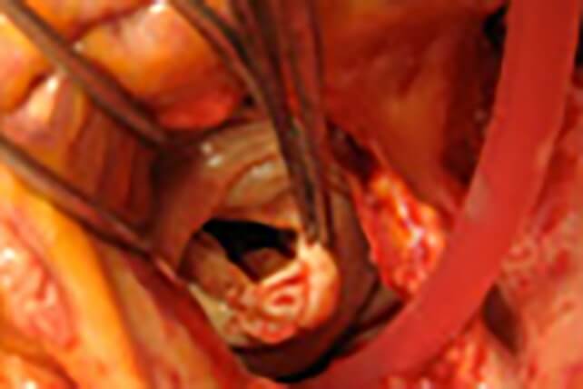 逆流の起きたべんの一部を切除の写真