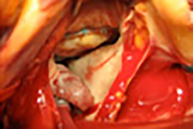 周りをリングを用いて補強の写真