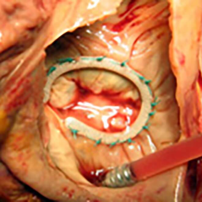 リングを用いた三尖弁形成術の写真