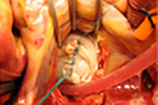 切除部分を縫い合わせるの写真